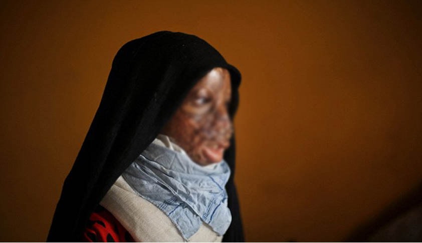 Consider including the names of Acid Attack Victims under the Disability List: Supreme Court [Read Judgment]