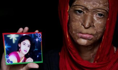 Equality Is Not Enough, Ensuring Equity In Acid Attack Legislation In India