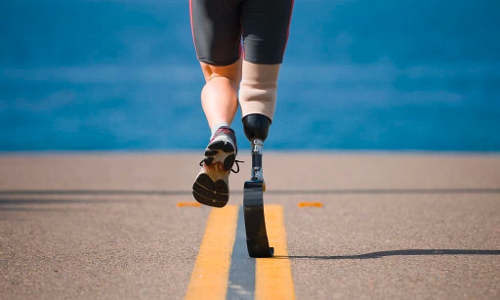 Supreme Court Stays Delhi High Courts Direction To Insurance Company To Provide Life-Time Warranty On Prosthetic Limbs Including Replacement