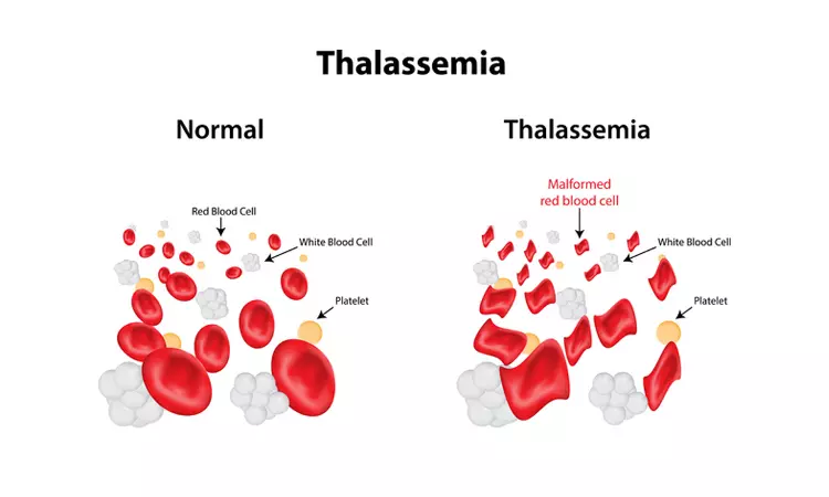 The Need For A Comprehensive Blood Law For India: Thalassemia In Focus The Need For A Comprehensive Blood Law For India: Thalassemia In Focus
