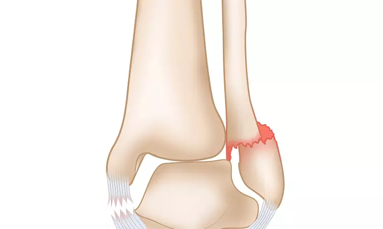 Unable To Prove Ankle Fracture Due To Rock Climbing Game, U.P. State Commission Dismisses Appeal Against Grand Venice Mall & Game Operators Unable To Prove Ankle Fracture Due To Rock Climbing Game, U.P. State Commission Dismisses Appeal Against Grand Venice Mall & Game Operators