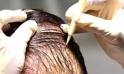 Delhi District Commission Holds DHI Asian Roots Liable For Conducting Hair Transplant Procedures Without Necessary License And Failure To Deliver Satisfactory Results Delhi District Commission Holds DHI Asian Roots Liable For Conducting Hair Transplant Procedures Without Necessary License And Failure To Deliver Satisfactory Results