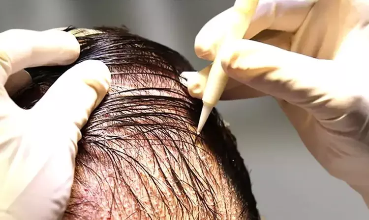 Delhi District Commission Holds DHI Asian Roots Liable For Conducting Hair Transplant Procedures Without Necessary License And Failure To Deliver Satisfactory Results Delhi District Commission Holds DHI Asian Roots Liable For Conducting Hair Transplant Procedures Without Necessary License And Failure To Deliver Satisfactory Results